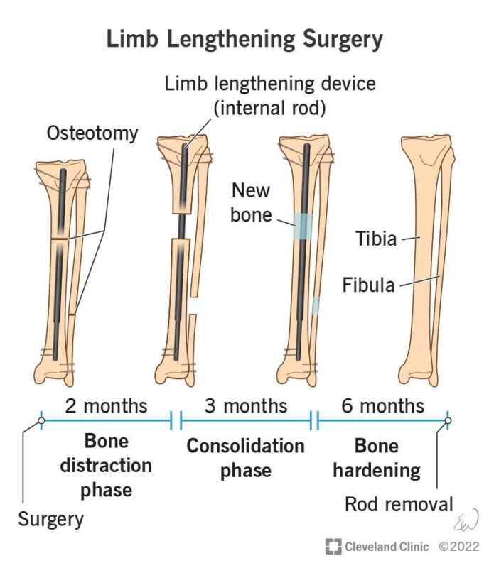 height surgery recovery time