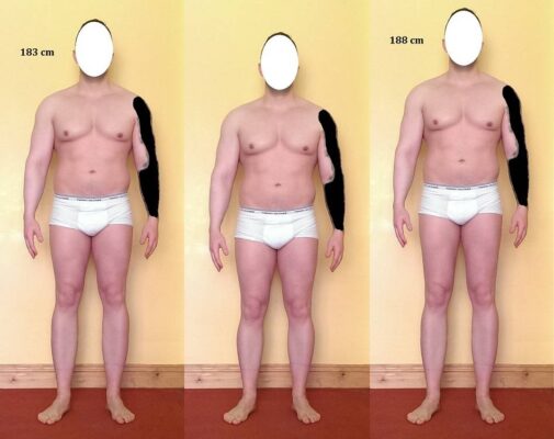 leg lengthening forum