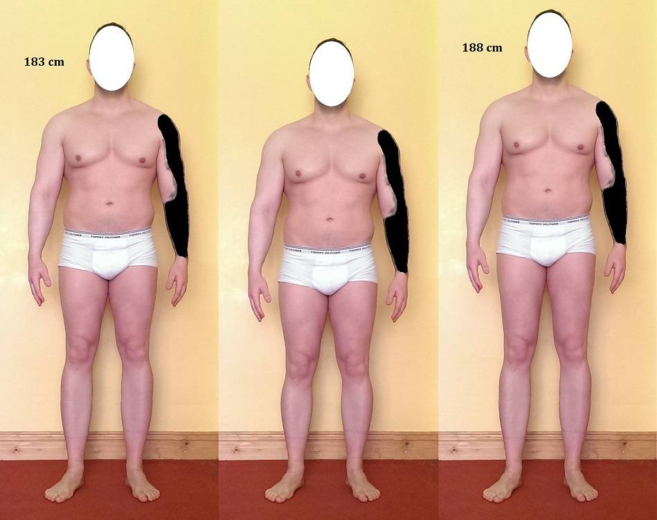 leg lengthening forum